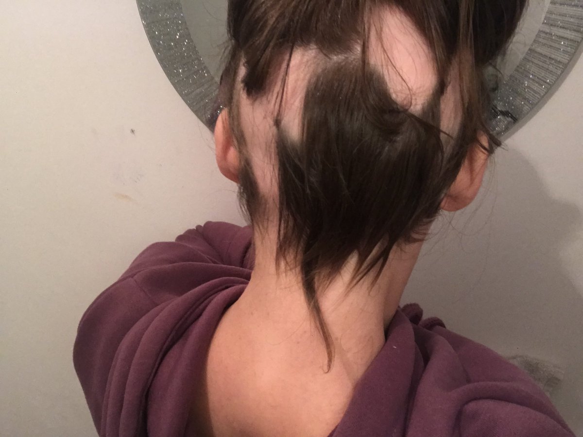 AleaCarr_'s tweet photo. I cannot believe it has been exactly 10 years since I found my very first ever bald patch. The fact I’ve lived more than half my life without all my hair makes me proud of myself for being so strong. I may never find a way to deal with alopecia but I’ll always keep trying 👶🏻💙 https://t.co/T2S1a62EUN
