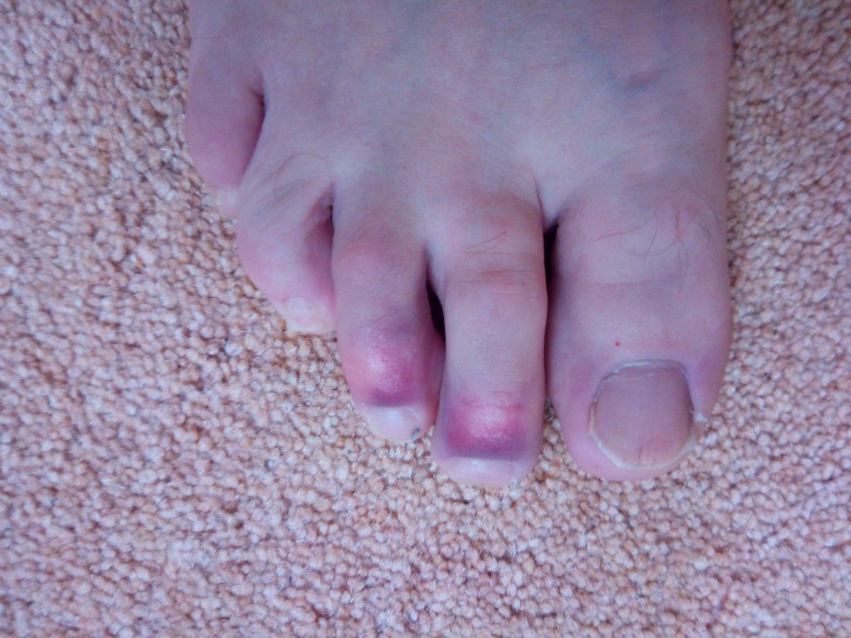 MilitaryMemento's tweet photo. Thanks to the cockwomble driving a white @PorscheGB 4x4 in #Tetbury yesterday afternoon, I now have 3 broken toes. Clearly anyone who is stupid enough to pay extra money to get a #Porsche badge on a #VW is too stupid to read the highway code when it comes to pedestrian crossings. https://t.co/0NebBRGVxq