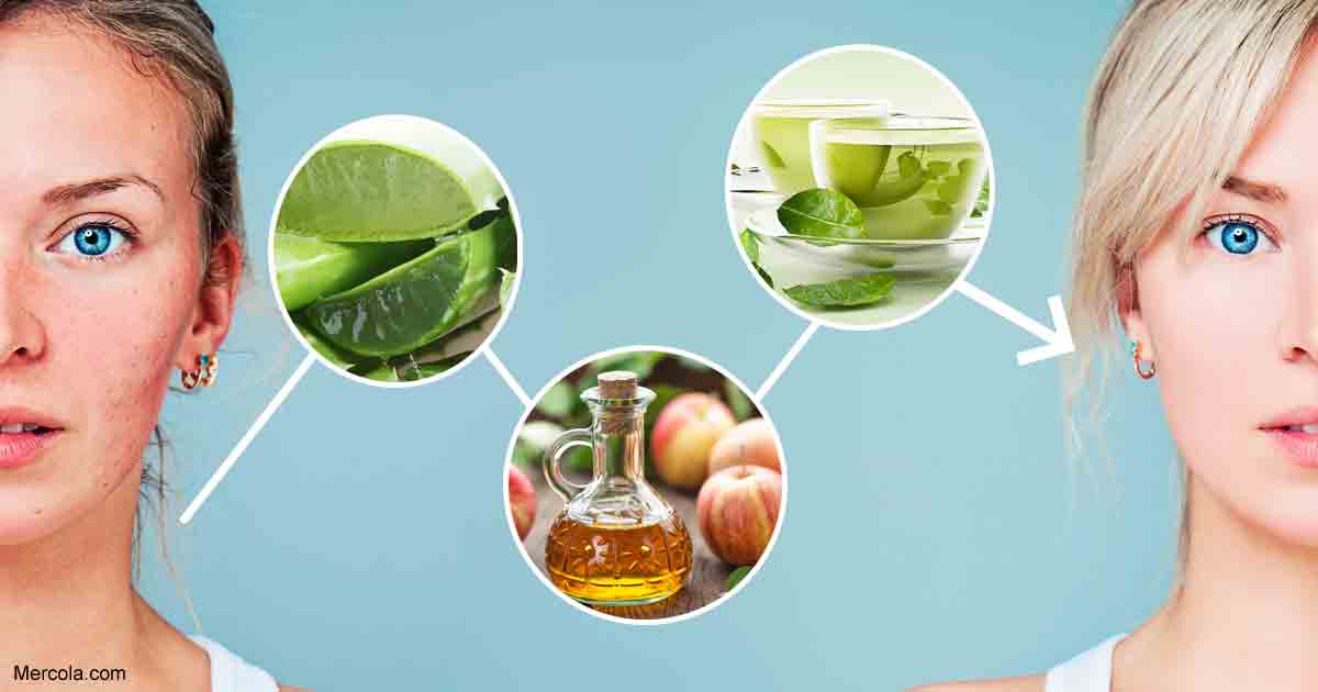 YvonneDuffeDO's tweet photo. Learn These 6 Powerful &amp; Effective #HomeRemedies for #Acne https://t.co/zQmRSzQ3at