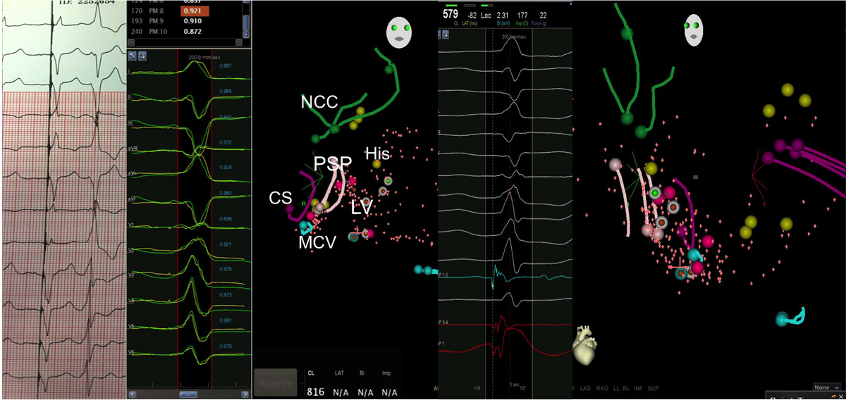 Cardiac Crux and surrounding targets for ablation. Happy holidays!