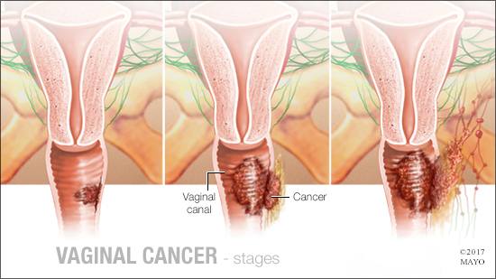 Mayo Clinic på Twitter: "Vaginal cancer most commonly occurs in the cells that line the surface of the vagina. Learn about the symptoms and risk factors for vaginal cancer, and why early