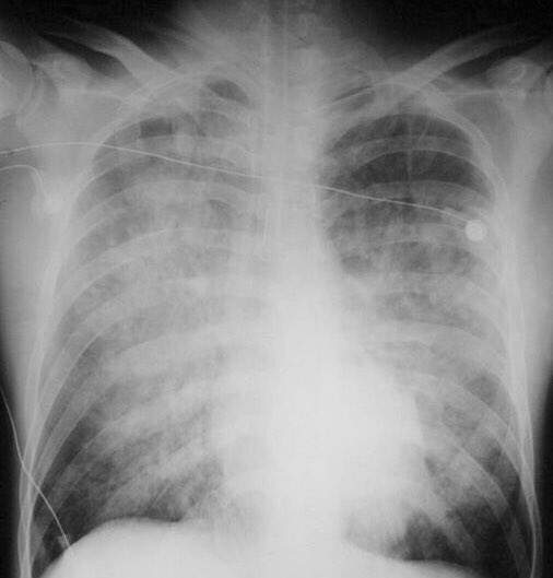 Dr Rafidah Abdullah On Twitter Jika Buah Pinggang Rosak Penghasilan Urin Akan Jadi Kurang Jadi Air Berkumpul Didalam Badan Lama Kelamaan Akan Banjir Di Dalam Paru Paru Untuk Lemah Jantung Perjalanan Darah Tidak