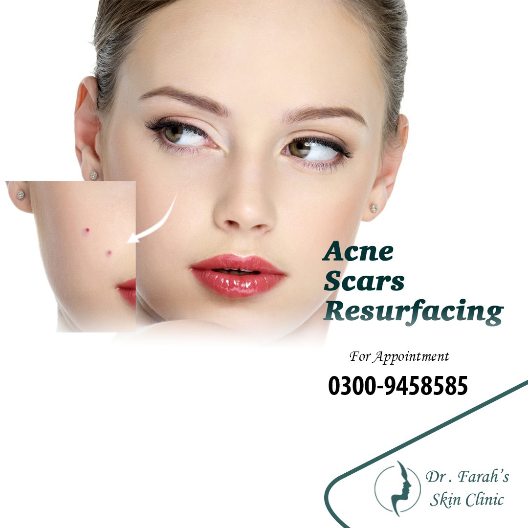 drfarahaamir's tweet photo. Acne Scars Treatment
Book Your Appointment Call: +92-300-9458585 https://t.co/qeHXVwqbAg

#acne #acnescar #dermatologist #skincare #skin #face #facial #beauty #drfarah #skinclinic #cosmeticdermatology #cosmeticclinic #skinspacialist #melasma #femaledoctor #acnescars #lahore https://t.co/yq5R708FGR