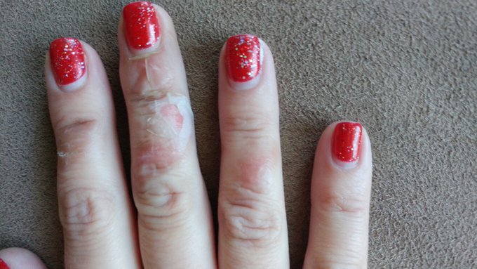 Hand is healing up...even tho it might look kinda gross lol😜 https://t.co/L8qVN3PQ2L<a href="/tag/femdom"class="tags"><span>#femdom</span></a><a href="/tag/cbt"class="tags"><span>#cbt</span></a>