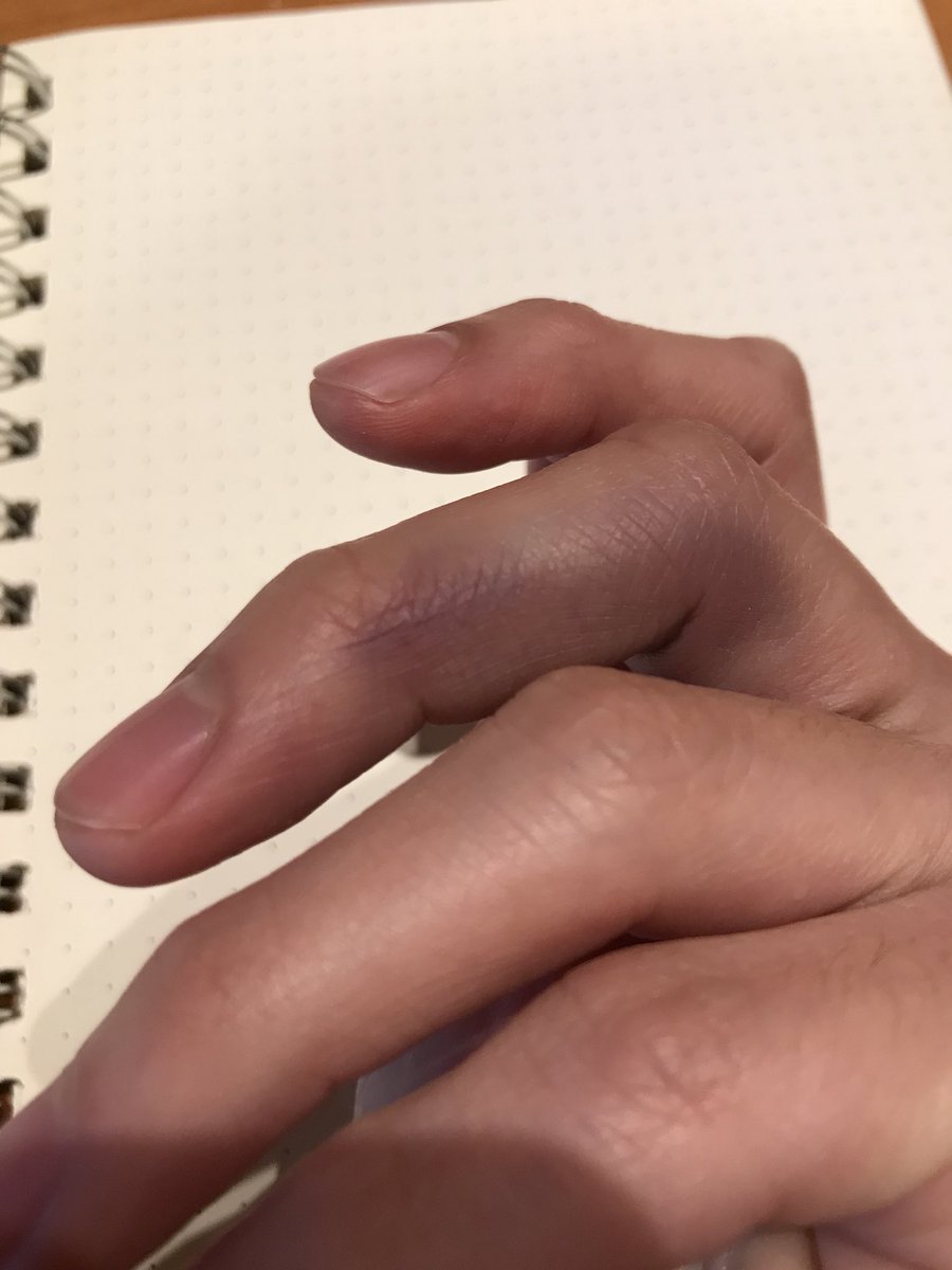 チュランペット としぱんち ゆ 指パッチンしたら中指がめっちゃ腫れてきたんすけど これってヤバいやつですかね とテンパってた愛ちゃんの順平 貧弱すぎ きち T Co Pash2aibwg Twitter