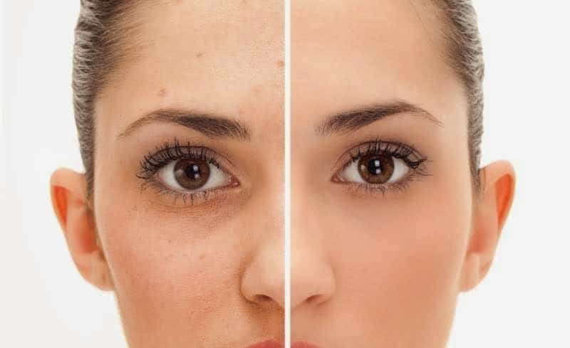 LTJoyfullife's tweet photo. 10 Super Clever Natural Ways on How to Remove Acne Scars 

Super Clever Nat ... https://t.co/0jL1tu2yRF https://t.co/VnLBN2fgnd