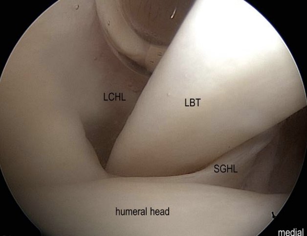SMUGcourses's tweet photo. confused about the anatomy of rotator interval? This article outlines anatomy including ultrasound anatomy. Look for abnormalities in adhesive capsulitis: soft tissue thickening and increased blood flow RI, thickening of CHL @lorenzo_masci @JeremyLewisPT https://t.co/vXVQglsIIT https://t.co/aP1u8HjnW4