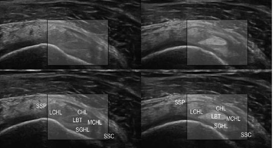 SMUGcourses's tweet photo. confused about the anatomy of rotator interval? This article outlines anatomy including ultrasound anatomy. Look for abnormalities in adhesive capsulitis: soft tissue thickening and increased blood flow RI, thickening of CHL @lorenzo_masci @JeremyLewisPT https://t.co/vXVQglsIIT https://t.co/aP1u8HjnW4