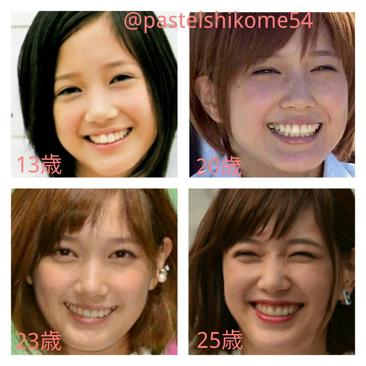 パステルしこめ 本田翼の顔面変化 二重幅が広がる 目頭の形に変化なし 上奥歯2本下前歯1本抜歯 19歳から歯列矯正開始 25歳で終了 上顎の歯を内向きに曲げたのと 歯列矯正ワイヤーの締めつけが痛くて食事量が減ったのか 頬が痩け下顎がゲッソリ