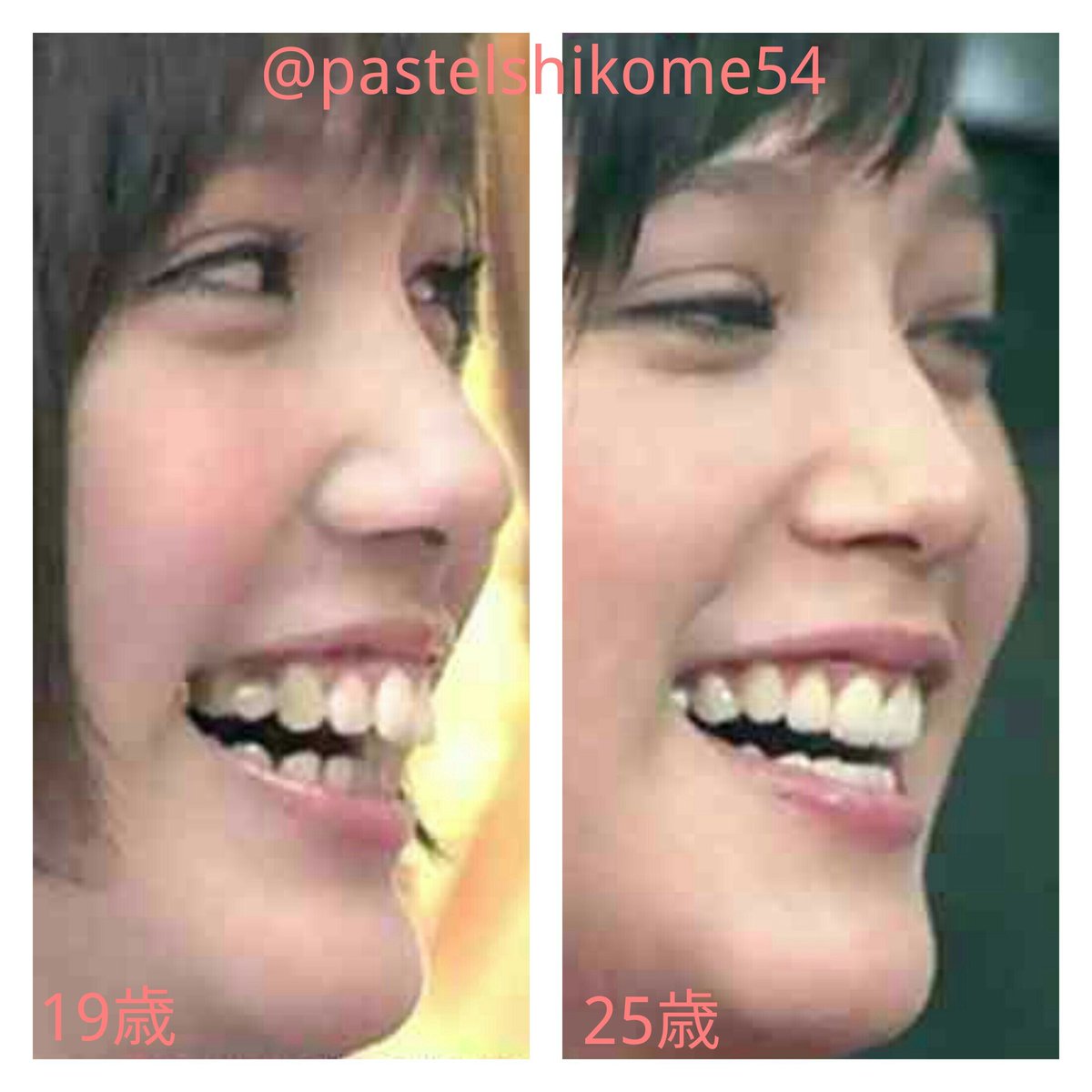 パステルしこめ 本田翼の顔面変化 二重幅が広がる 目頭の形に変化なし 上奥歯2本下前歯1本抜歯 19歳から歯列矯正開始 25歳で終了 上顎の歯を内向きに曲げたのと 歯列矯正ワイヤーの締めつけが痛くて食事量が減ったのか 頬が痩け下顎がゲッソリ