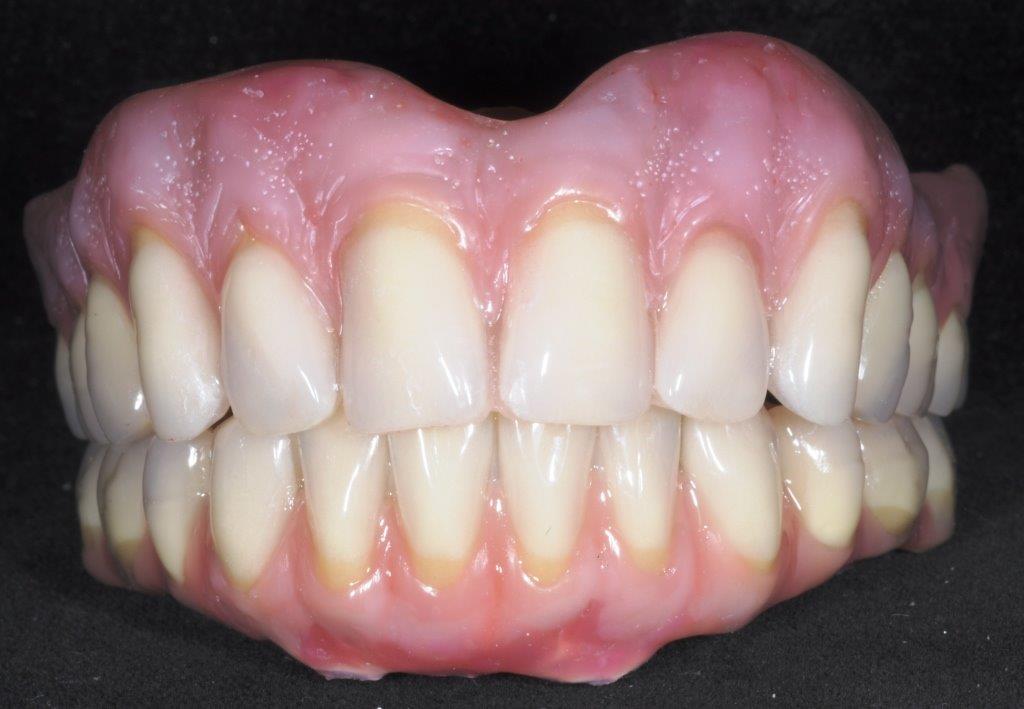 TBDentalLab's tweet photo. Upper overdenture and lower implant bridge using soon be be launched new gum composite from a leading UK dental company https://t.co/s6PTgqTi3x