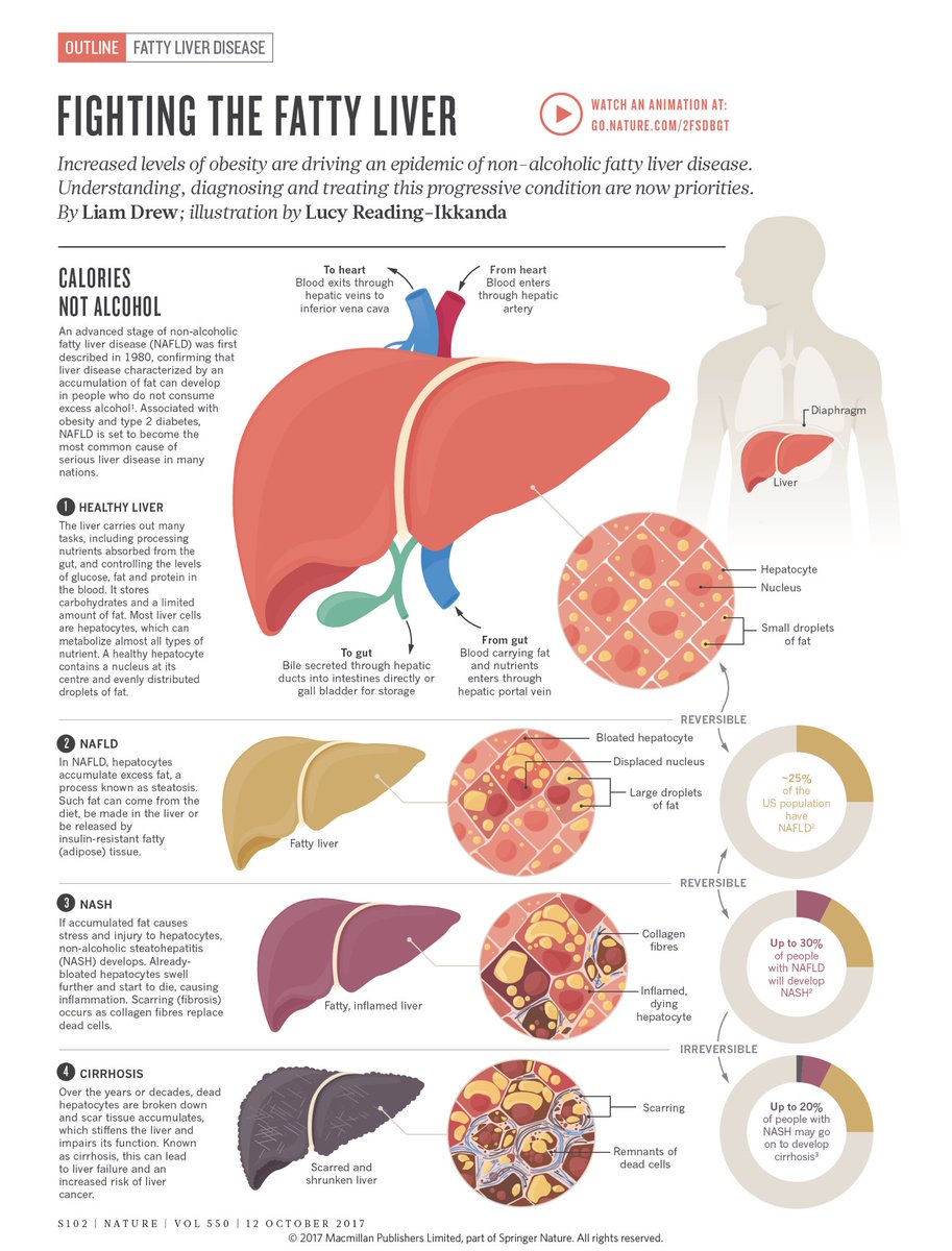 توییتر \ Lucy Reading-Ikkanda در توییتر: «..And the companion video: Non-alcoholic fatty liver disease (NAFLD) that has doctors and scientists worried: 1 in 4 people are now affected by this fatty-liver condition. توییتر \ Lucy Reading-Ikkanda در توییتر: «..And the companion video: Non-alcoholic fatty liver disease (NAFLD) that has doctors and scientists worried: 1 in 4 people are now affected by this fatty-liver condition.