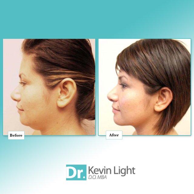 DrKDLight's tweet photo. Check out these amazing #BeforeAndAfter results with #Liposuction. 

Call today to schedule your consultation. 

#FatRemoval #DoubleChin #Texas #DrKevinLight #Lipo #WednesdayWisdom #Confidence #DrKevinLightCosmeticSurgery  #Plano #TX https://t.co/NHOWektDJo