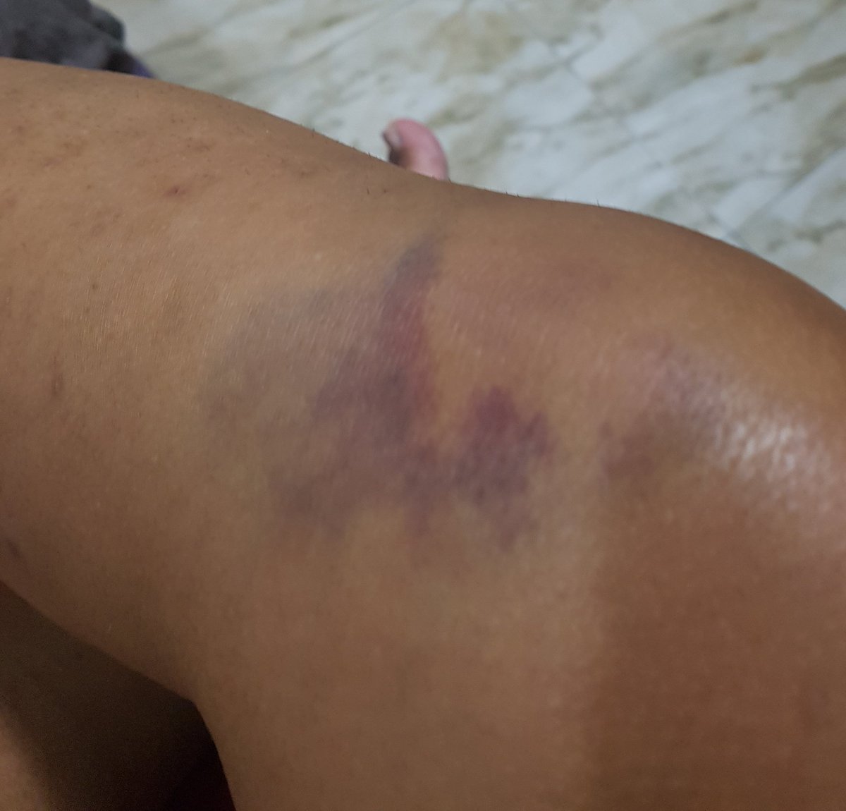 lanenasw's tweet photo. Viendo the Crown y reposando la rodilla, una semana después aun me duele pero ella no puede mas que yo!! https://t.co/pxtY22hU78