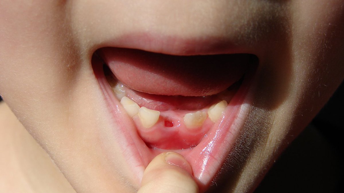 Baby tooth saves Miami-Dade teenager from felony charge bit.ly/2DobDZH https://t.co/8VO3ywzyO8