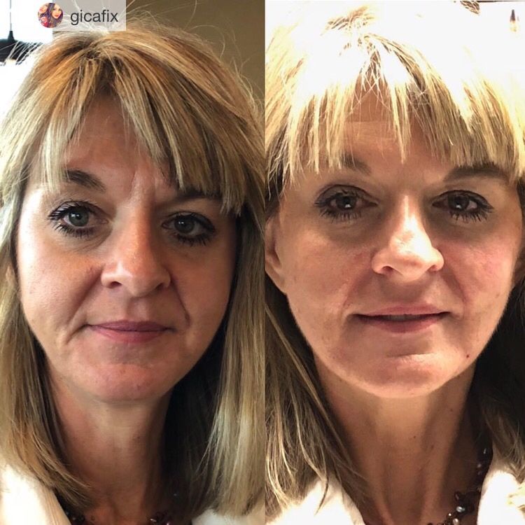 nlimedspa's tweet photo. This client wanted to feel refreshed and see instant results for the holidays. We decided to do PDO threads to the mid face during her lunch break! Came in looking tired, came out looking brighter and refreshed!
☎️Phone: 1(800)851-0969

🌎Website: https://t.co/GYvojI5w8I https://t.co/VXrOP5puGw