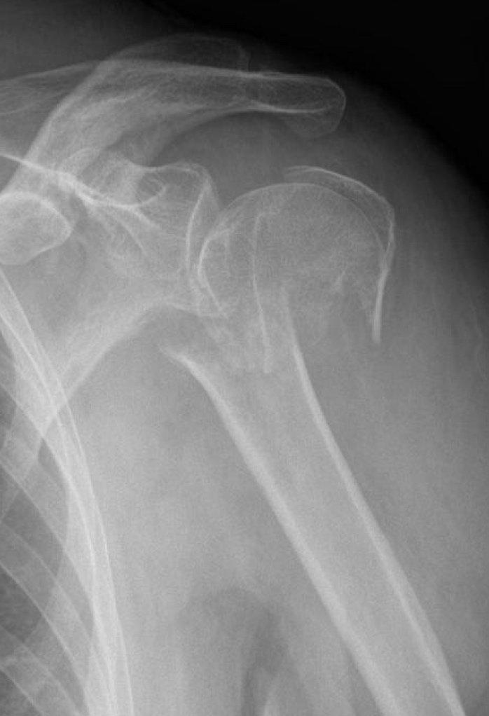 BrentMorrisMD's tweet photo. What is a proximal humerus fracture, and what are treatment options for a #shoulder #fracture? Dr. Brent J. Morris Houston Shoulder & Elbow Surgeon treats shoulder fractures: https://t.co/RXef4qP1Ao #proximalhumerus #shoulderfracture #shoulder https://t.co/30sfBPjtyU