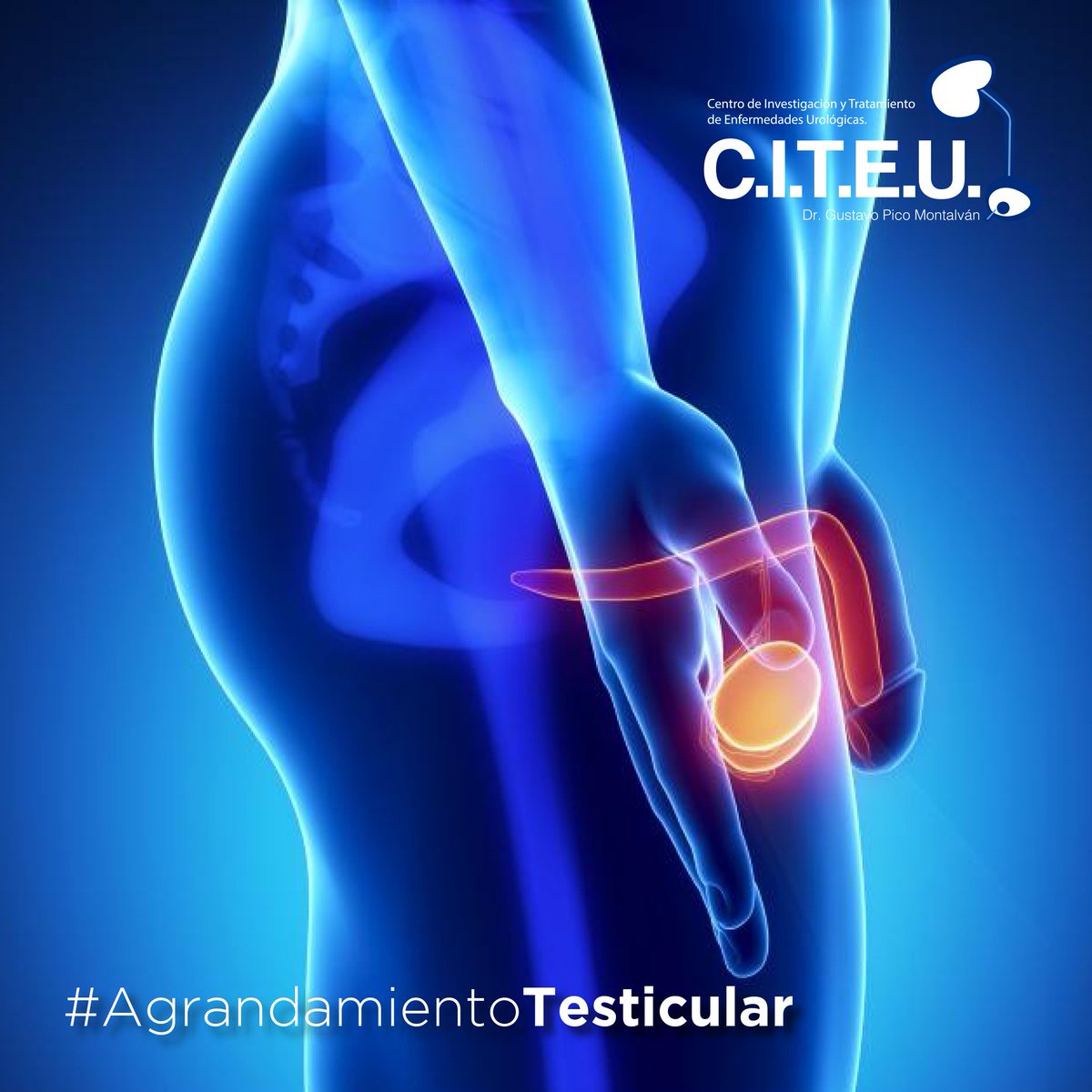 citeu_ec's tweet photo. Agrandamiento testicular: puede darse en uno o ambos testículos. Ten en cuenta que es normal que un testículo cuelgue ligeramente más bajo que el otro y que uno también sea ligeramente más grande que el otro. 
#DrGustavoPico #CITEU #Urología #CálculosUrinarios https://t.co/QT9fA5KoQz