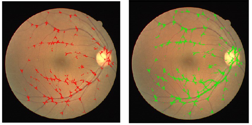 J_Imaging_MDPI's tweet image. #AutomaticDetection and Distinction of #Retinal #Vessel Bifurcations and Crossings in Colour Fundus #Photography #MedicalImaging #Imaging #MIUA2017  #OpenAccess🔓
