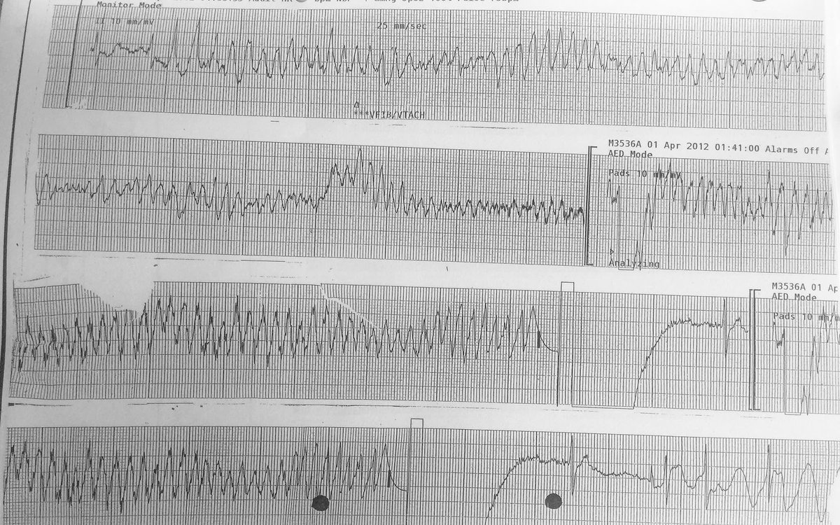 ClarCahill's tweet photo. #KCNH2 #mutation #channelopathy #LQT2 #ECG Over 5 years post V fib cardiac arrest & thankfully life’s goes on ❤️ #SADs Life is a gift - make it worthwhile. #ICD #AED @CRYIre @Irishheart_ie #SoMuchToLiveFor https://t.co/puAINY7M0c