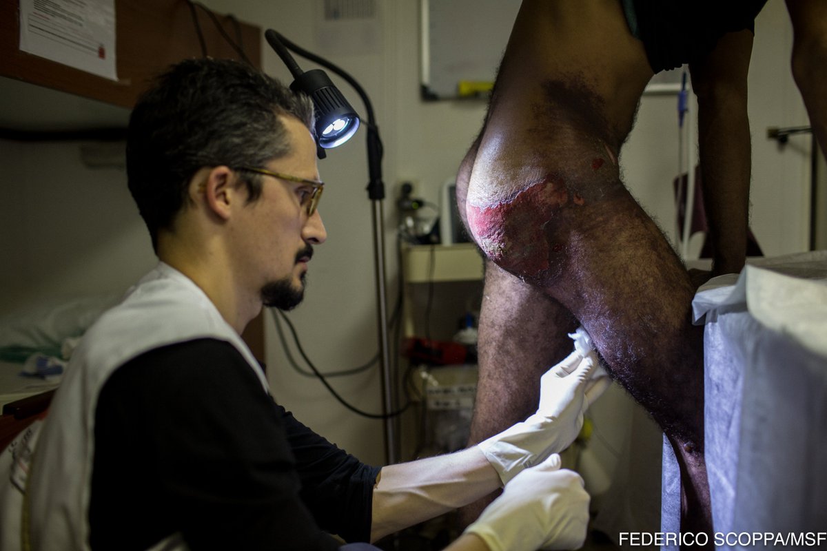 MSF_Sea's tweet photo. Since yesterday, @MSF medics on board #Aquarius treated 20 people with severe fuel burns. It's a recurrent serious health issue we see especially in women rescued. They're caused by the toxic mix of fuel and sea water that gets inside the rubber boats and burns people's skin. https://t.co/3oK3W3SF8D