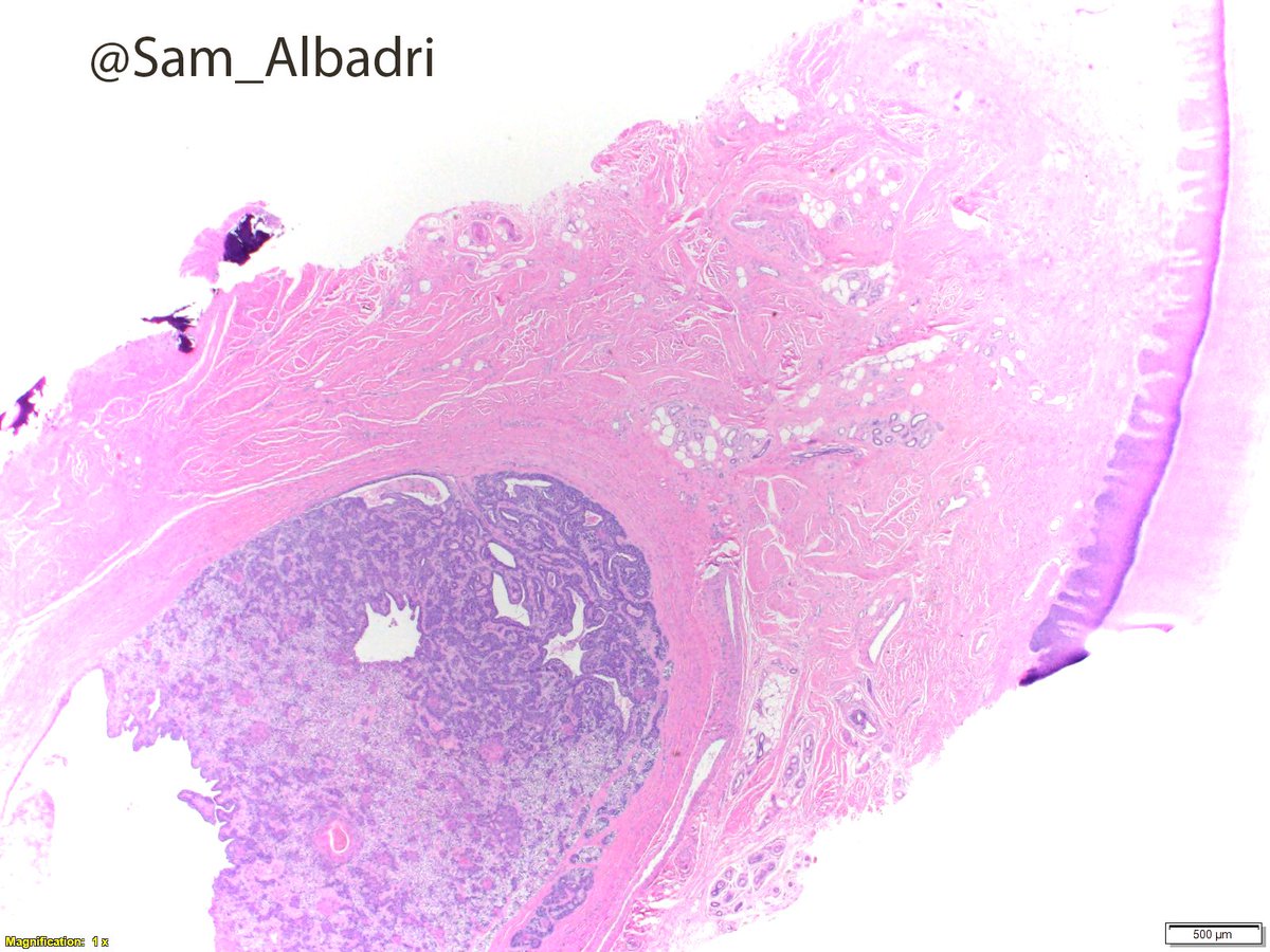 sam_albadri's tweet photo. Thumb mass.Dx? @IntSocDermpath @DrAldehyde @AmyHDeekenMD @SGottesmanMD @GeronimoJrLapac @NadiaUSAMC @kriyer68 @ElshaikhMD @RiyamZreikMD @aakasharmand @RoseannIWu @marenwhymd @marcoslepe @KCampbellMD @JaniceWilsonMD @VijayPatho @lara_pijuan @pembeoltulu @plessthanpt001 #pathology https://t.co/s5ifF9F0Kv
