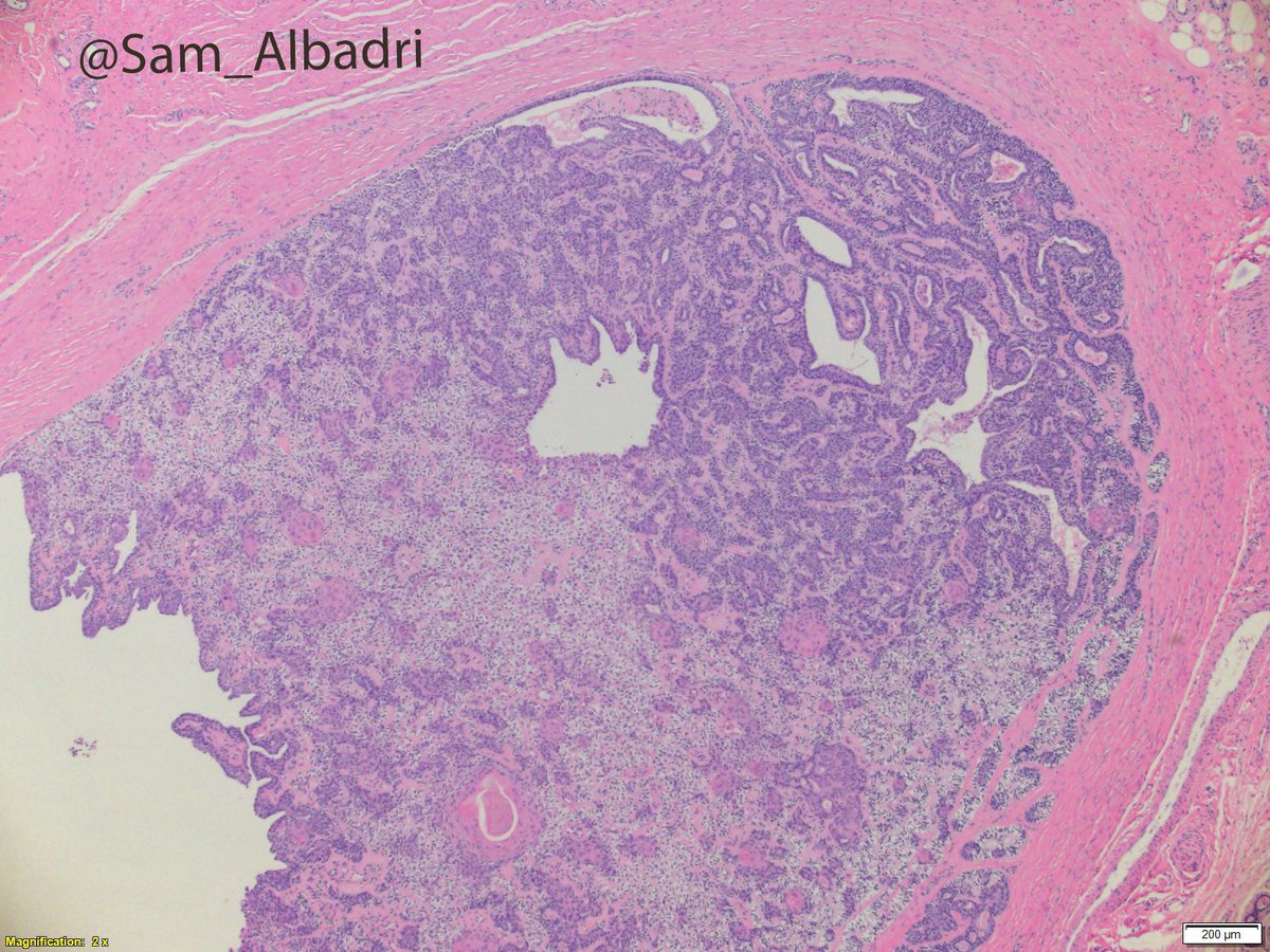 sam_albadri's tweet photo. Thumb mass.Dx? @IntSocDermpath @DrAldehyde @AmyHDeekenMD @SGottesmanMD @GeronimoJrLapac @NadiaUSAMC @kriyer68 @ElshaikhMD @RiyamZreikMD @aakasharmand @RoseannIWu @marenwhymd @marcoslepe @KCampbellMD @JaniceWilsonMD @VijayPatho @lara_pijuan @pembeoltulu @plessthanpt001 #pathology https://t.co/s5ifF9F0Kv