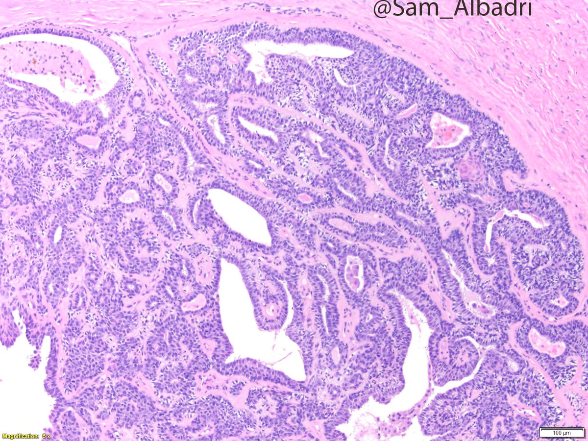 sam_albadri's tweet photo. Thumb mass.Dx? @IntSocDermpath @DrAldehyde @AmyHDeekenMD @SGottesmanMD @GeronimoJrLapac @NadiaUSAMC @kriyer68 @ElshaikhMD @RiyamZreikMD @aakasharmand @RoseannIWu @marenwhymd @marcoslepe @KCampbellMD @JaniceWilsonMD @VijayPatho @lara_pijuan @pembeoltulu @plessthanpt001 #pathology https://t.co/s5ifF9F0Kv