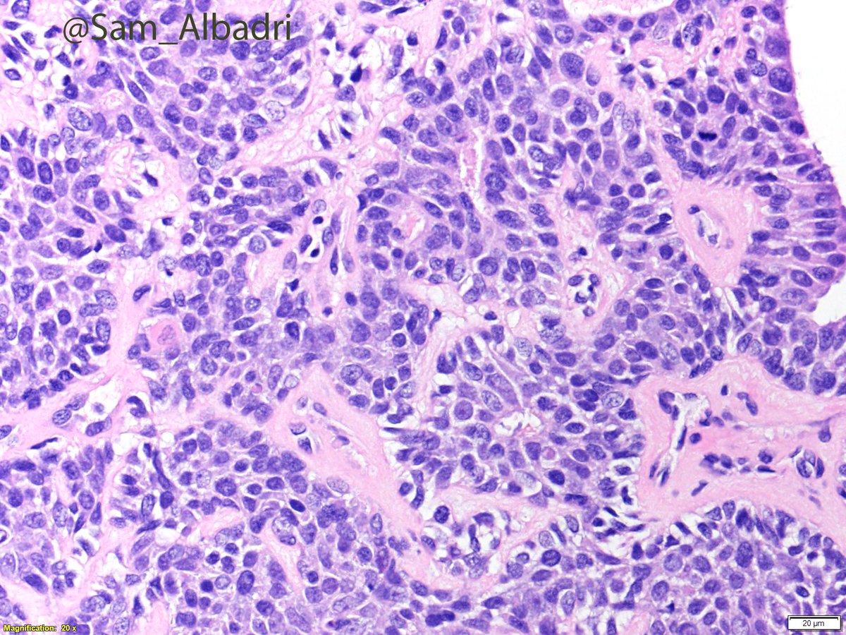 sam_albadri's tweet photo. Thumb mass.Dx? @IntSocDermpath @DrAldehyde @AmyHDeekenMD @SGottesmanMD @GeronimoJrLapac @NadiaUSAMC @kriyer68 @ElshaikhMD @RiyamZreikMD @aakasharmand @RoseannIWu @marenwhymd @marcoslepe @KCampbellMD @JaniceWilsonMD @VijayPatho @lara_pijuan @pembeoltulu @plessthanpt001 #pathology https://t.co/s5ifF9F0Kv