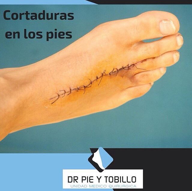 Cuidado con las cortaduras en los pies instagram.com/p/BdPyRBvAEk3/ #drpieytobillo #traumatologia