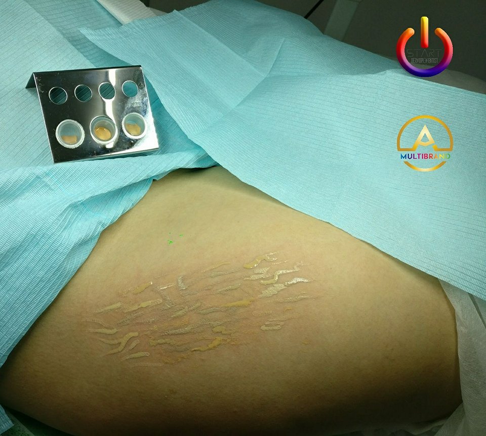 MariaMargineanu's tweet photo. Medical pigmentation offers visual and aesthetic camouflage of the injured area. 
 -------------------------
 https://t.co/dCyxiEINBI
 #anamariamargineanu #startacademy #training #stretchmarks #Medicalpigmentation https://t.co/5k2TvMuED4