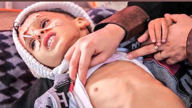 Rightword2012's tweet photo. A sad update from our recent @abc730 on the #Saudi surrender or starve tactics that are killing #Yemen's children. Little Mohammad featured in our report has died as a result of his acute malnutrition. Remember these kids this Christmas. 500,000 are starving right now in #Yemen💔 https://t.co/GN9H0osUeX