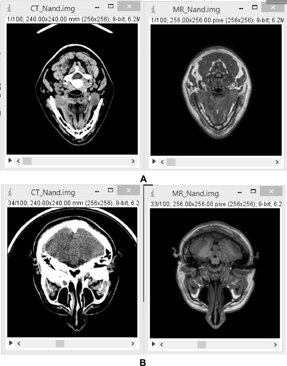 BiomedJ's tweet image. #Multiresolution image registration for multimodal brain images and fusion for better neurosurgical planning
sciencedirect.com/science/articl… #surgery #Neurosurgery