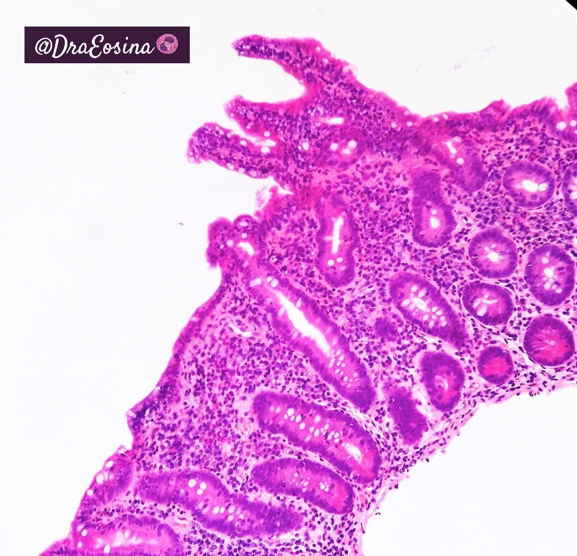 DraEosina's tweet photo. Dear Tweeples, can you build a story for this biopsy?
#GIPath #Histognosis #Pathstories #Pathology
(@slusagar be quiet! ๐๐) https://t.co/DyZMk9v0ew