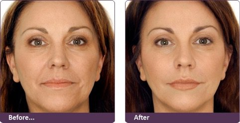 DiamondBotox's tweet image. 2018 - Make it the year of "NEW YEAR NEW ME" with our amazing Botox Treatment, launching 8th Jan! Book now by calling 01603 819125 or book online at diamondskincare.co.uk 2018 should be a year to remember #norwich #botox #newyearnewyou