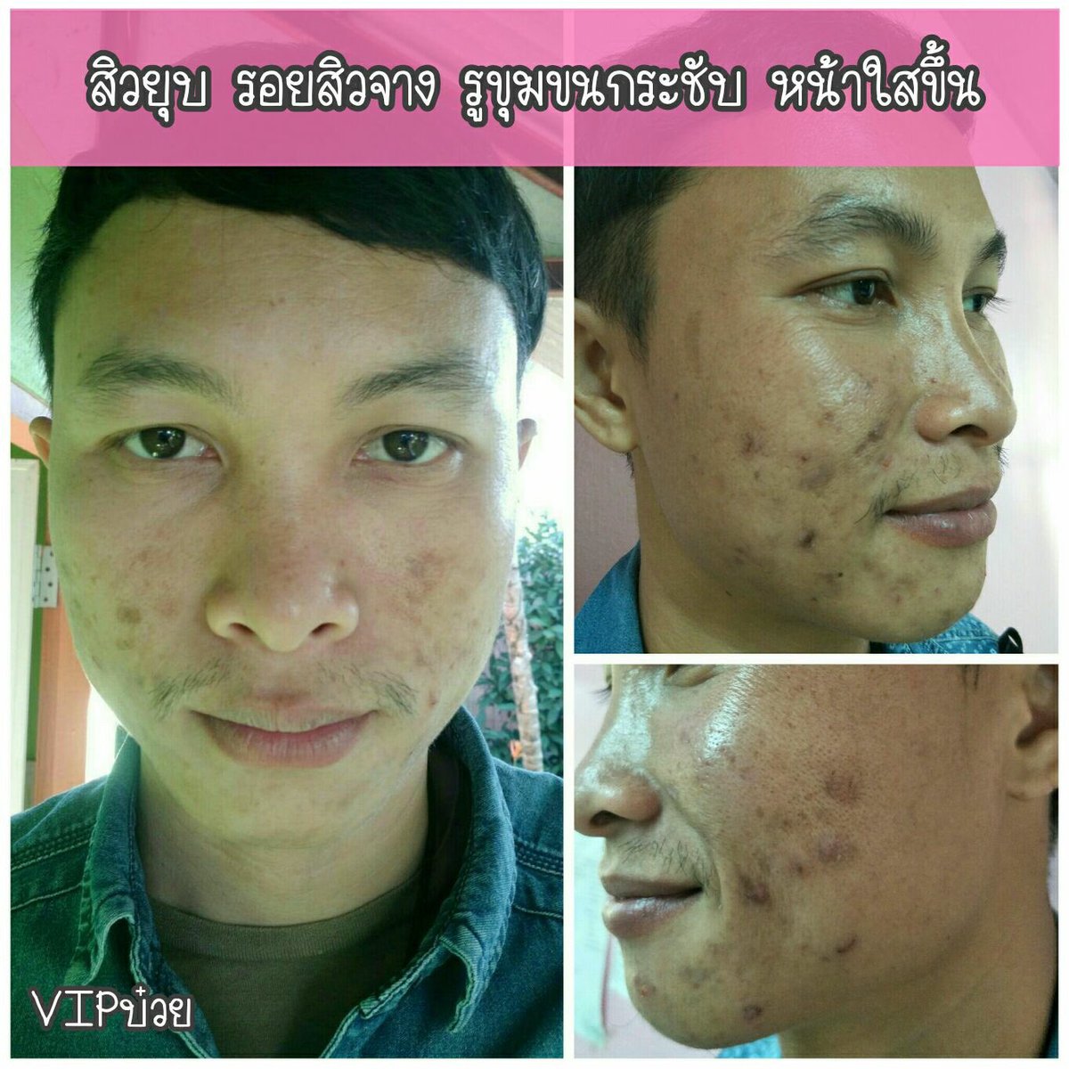 MilkyKatanee's tweet photo. หนุ่มออฟฟิตที่ทำงานสิวเห่อ หน้าหมองมีรอยสิว ผิวหน้าแห้งกร้าน จัดเจลลี่มาส์กไป🥒🍃หน้าใสขึ้น เรียบเนียน รูขุมขนกระช���บ ผิวหน้าดูชุ่มชื้นขึ้น รวมๆคือผิวหน้าสุขภาพดีขึ้นกว่าเดิมเยอะมาก😍อยากรู้ต้องลองเอง

#เรื่องสิวชิวมากกกก ❗️❗️เห็นผลในกระปุกแรกเลยคะ 
#Jellymask. 390.-💸❤️ https://t.co/kqXYfCTVyq