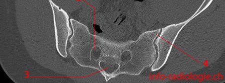 brandonlaz30's tweet image. If anyone is ever feeling down and depressed just google pictures of sacral CT scans to brighten your day up! #paschoolproblems