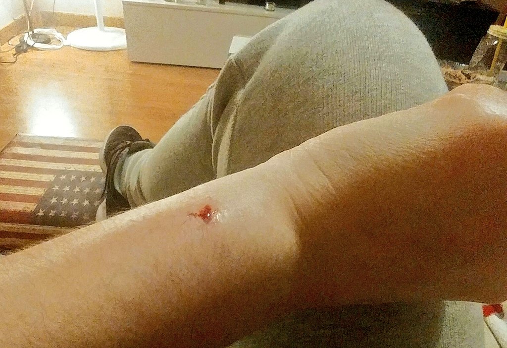 Krispistinaa's tweet photo. Cuando después de más de una semana de gripe, Akira te muerde justo en el hueso de la muñeca. No sé si es un brazo o un tobillo #Tullida https://t.co/AKxfiyJDfh