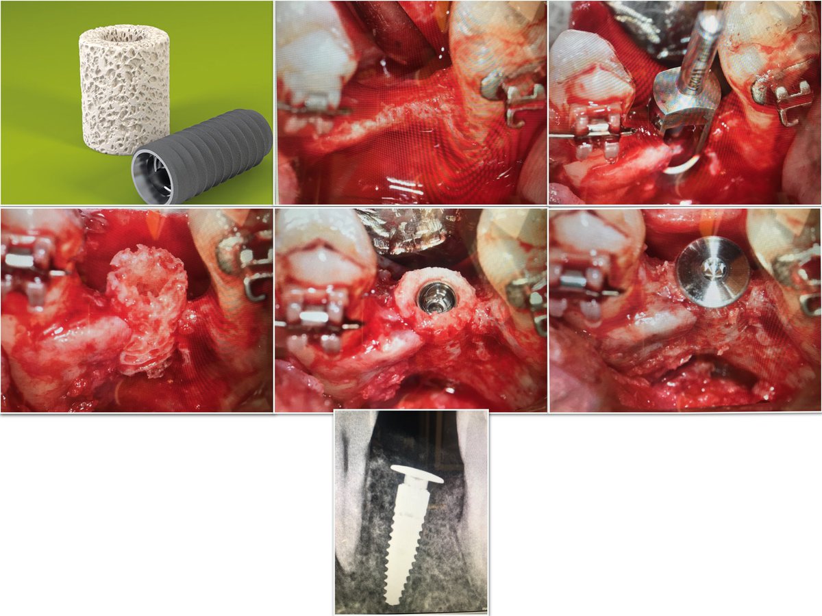 Another Straumann Bone Ring in West TX!  No pics of the additional allograft &amp; xenograft layer or membrane. #straumann #moreboneplease