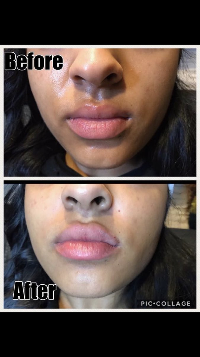 Madisoncmedspa's tweet photo. Before and after nasal fold and lip fillers using Juverderm https://t.co/wRfQVVivpi