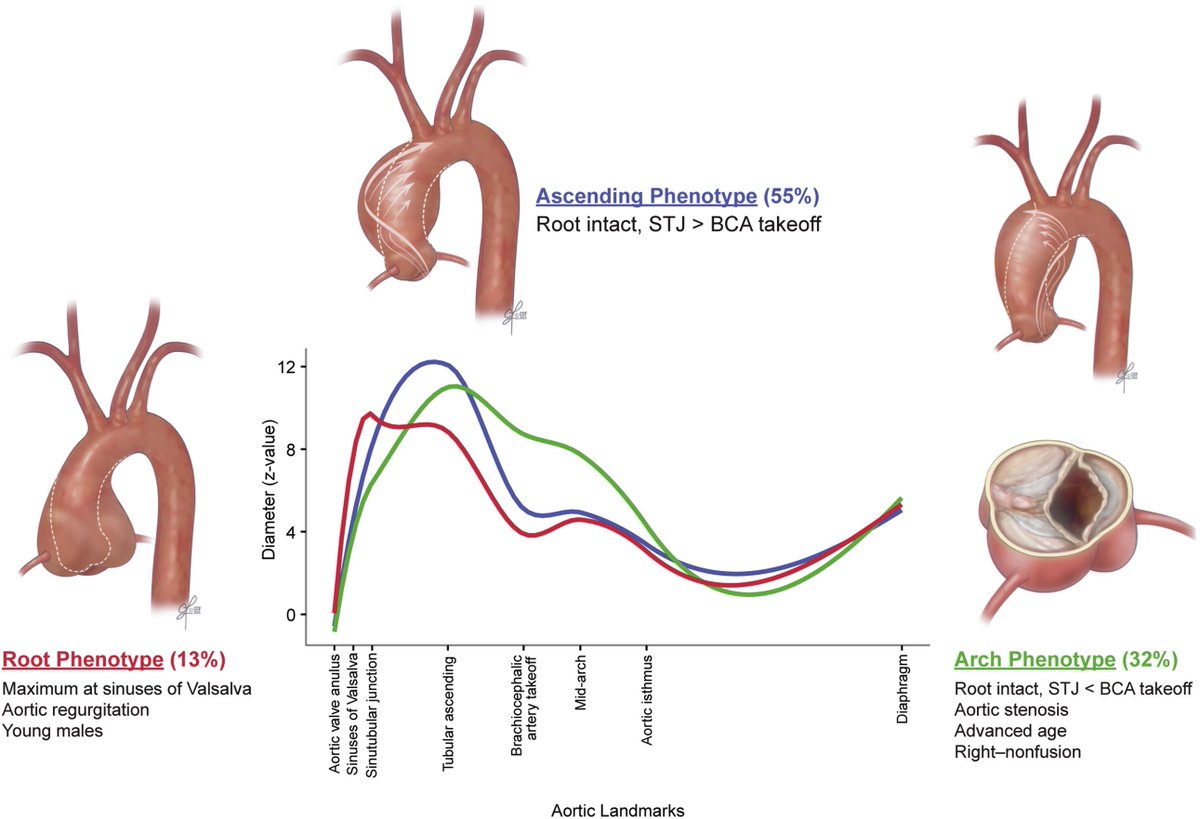 Richard Weisel (@rweisel12) on Twitter photo BAV aortopathy phenotypes: 656 3D CT scans <a href="/ClevelandClinic/">Cleveland Clinic</a>: Root type in younger males suggests a genetic etiology and arch type in older pts with AS, a hemodynamic process
Read Machine-learning in Feb issue of JTCVS at bit.ly/2C9LzlEJTCVS
<a href="/AATSJournals/">AATS Journals</a> <a href="/tssmn/">CTSurgSocMedNetwork</a> <a href="/OuzounianMD/">Maral Ouzounian</a> BAV aortopathy phenotypes: 656 3D CT scans <a href="/ClevelandClinic/">Cleveland Clinic</a>: Root type in younger males suggests a genetic etiology and arch type in older pts with AS, a hemodynamic process
Read Machine-learning in Feb issue of JTCVS at bit.ly/2C9LzlEJTCVS
<a href="/AATSJournals/">AATS Journals</a> <a href="/tssmn/">CTSurgSocMedNetwork</a> <a href="/OuzounianMD/">Maral Ouzounian</a>