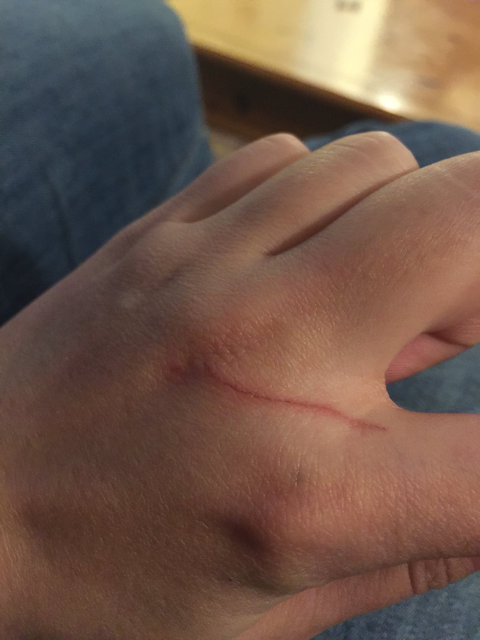 Top more than 138 are nail scratches dangerous best songngunhatanh.edu.vn