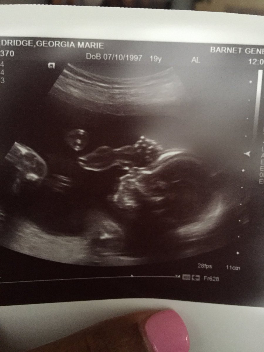 We’re Pregnant georgiamariew.wordpress.com/2017/12/30/wer…