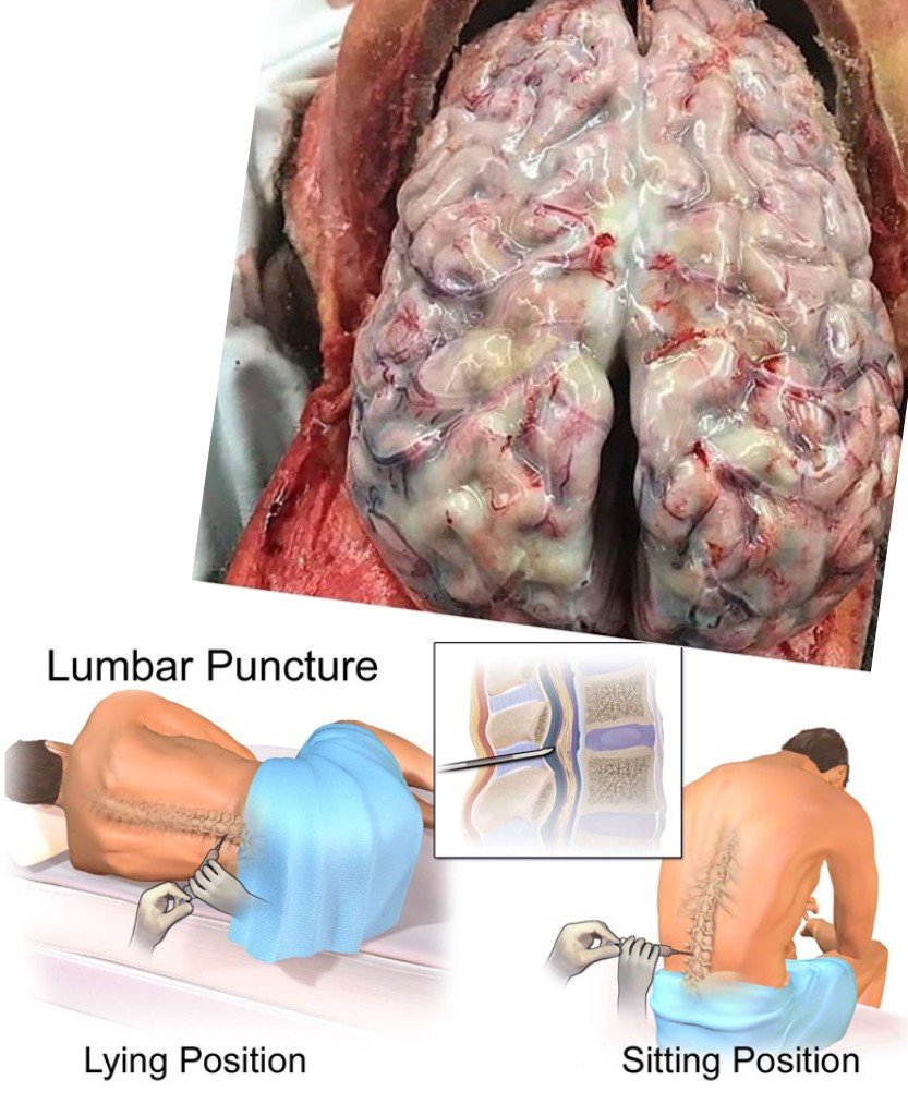 Helmi Senpai ãƒ˜ãƒ«ãƒŸå…ˆè¼© On Twitter Meningitis Jangkitan Selaput Otak Encephalitis Radang Otak Lumbar Puncture Pengambilan Air Tulang Belakang Indications Risk Safety Paediatric Internalmedicine Scroll On This Is A