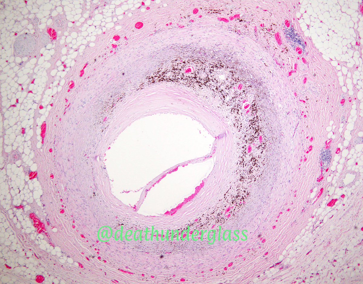 deathunderglass's tweet photo. Image of the day: left anterior descending coronary artery with dissection #forensic #pathology #dissection #PathArt #cardiovascularpathology https://t.co/de0QD8XdNY