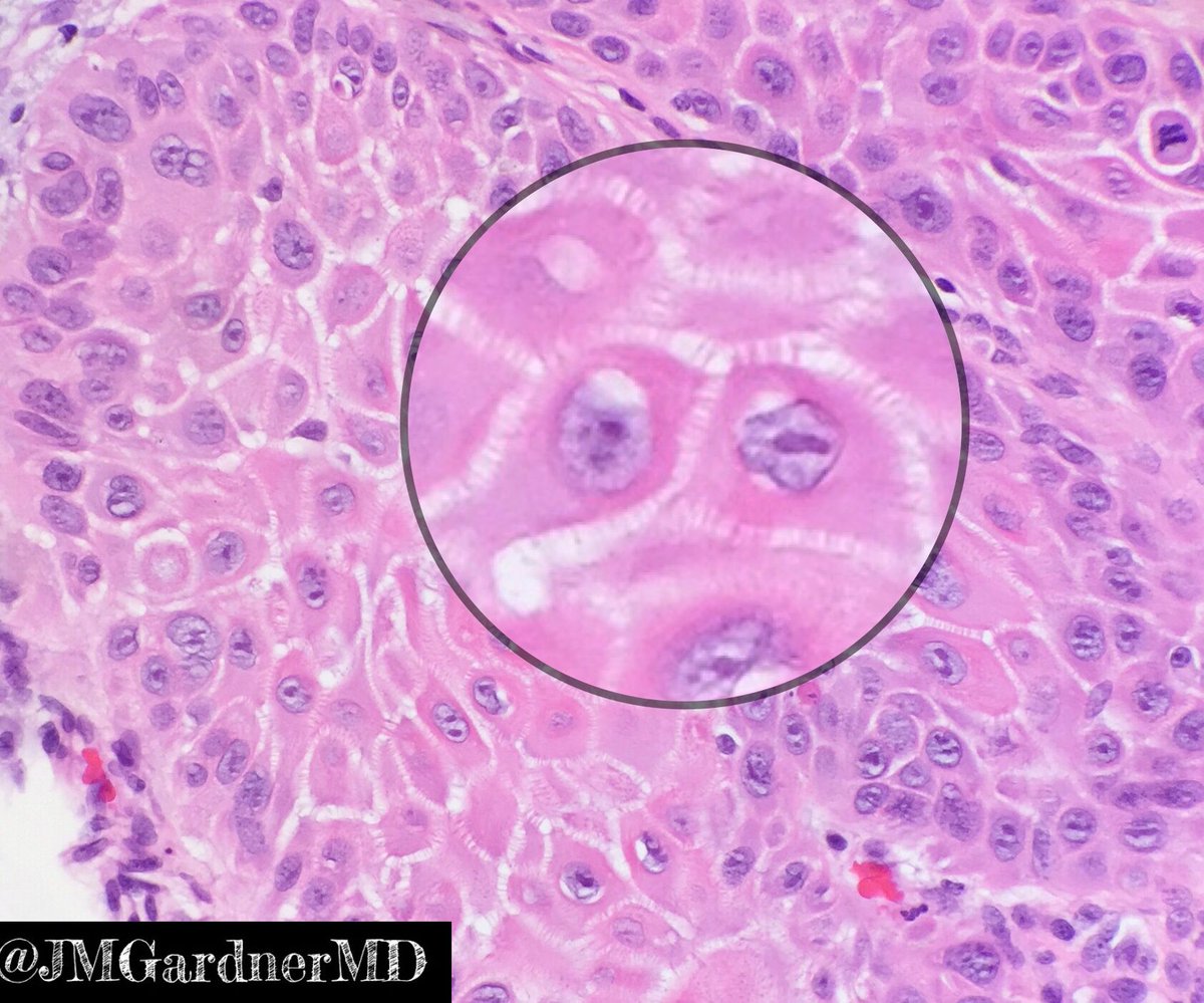 Intercellular Bridges In Scc