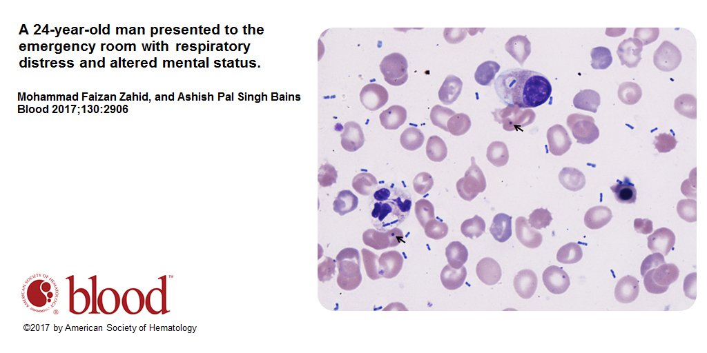 Blood Work: Rapidly fatal Klebsiella pneumoniae sepsis in a patient with pyruvate kinase deficiency and asplenia owl.li/zykl30hs99r
