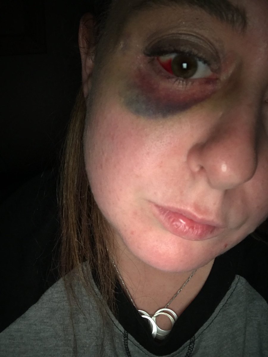 martinez111213's tweet photo. #AutismAwareness #aggression #son #Spectrum This is now a few days after the major melt down. The darkness in my eye will fade, but the mark on the chart from another aggressive behavior will never https://t.co/YHIqSLdrAe never know what to expect during meltdowns. #DontJudge https://t.co/oqbQJSKzIS