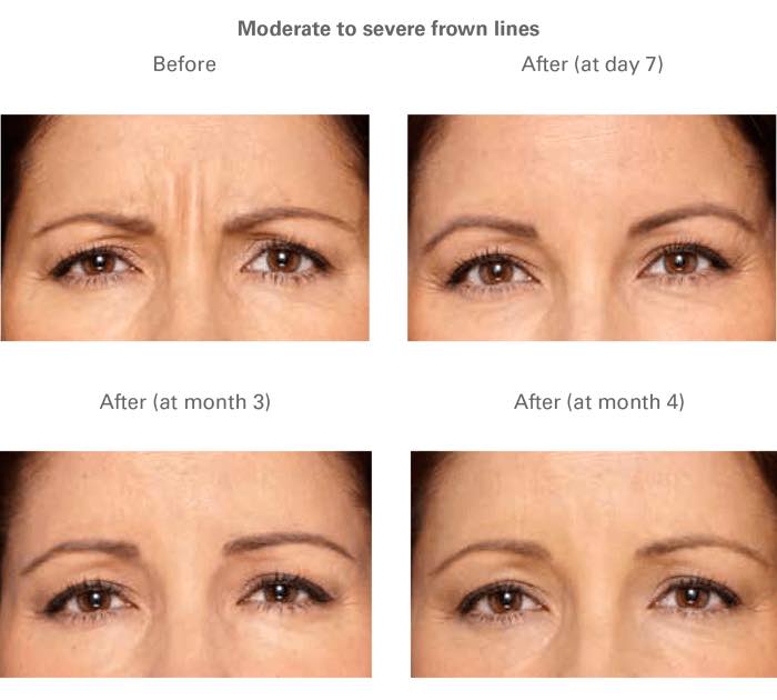 midwestaging's tweet image. #Botox cosmetic is the only approved treatment to improve the appearance of moderate to severe frown lines between the brows and crow’s feet lines in adults. Call us to schedule an appointment and see how we can help you!
Call 📞 us at: (815) 277-5229

#MedSpa #Aesthetics