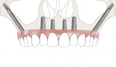 AdinImplantsLTD's tweet image. #Zygomatic #implants are an evidence-based surgical and prosthetic solution for both two-stage and #immediateloading protocols. Check out these treatment guidelines: hubs.ly/H09yzLB0 by @for_org